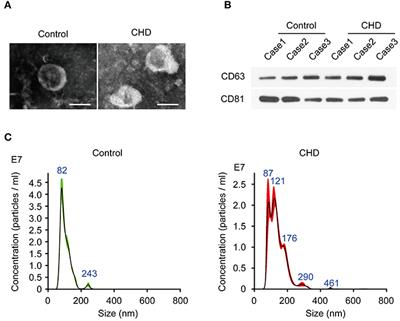 Plasma Exosomal S1PR5 and CARNS1 as Potential Non-invasive Screening Biomarkers of Coronary Heart Disease